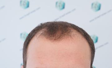 Dr. Rafael de Freitas - 4,818 Grafts - 11,085 Hairs - FUE + DHI