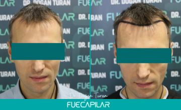 Dr. Turan - FUECAPILAR Clinic, NW III , 3418 grafts