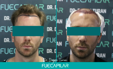 Dr. Turan - FUECAPILAR Clinic, NW III, 2738 grafts