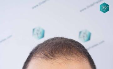 Dr. Rafael de Freitas - 4.516 Grafts - FUE - Clínica de Freitas