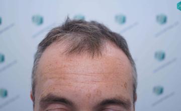 Dr. Rafael de Freitas - 4.924 Grafts - FUE + DHI