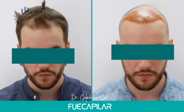 Dr. Gur - FUECAPILAR Clinic, NW IIv (diffuse thinning in the frontal area), 1959 grafts