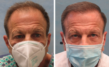 Norwood 6 3,036 Grafts - Dr. Robert Bernstein