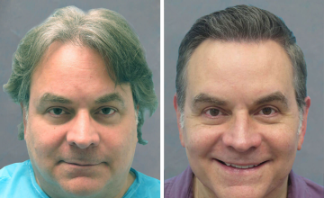 Norwood 4A 1,195 and 1,077 grafts Grafts FUT - Dr. Robert Bernstein