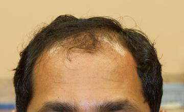Michael Vories, MD FUE 2500 Grafts