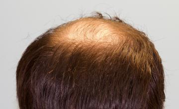 Michael Vories, MD FUE 2000 Grafts Vertex