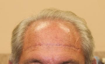 Michael Vories, MD 2500 FUE Grafts