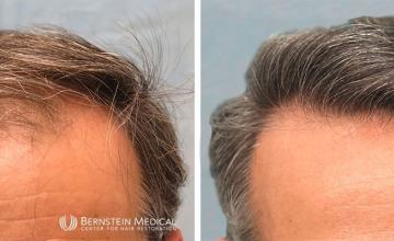 Norwood Class 4A 2,132 Grafts FUT - Dr. David Bernstein