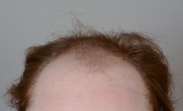 Robert Haber, MD - 2595 grafts FUT, Front and midscalp - 1 Year