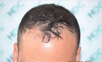 Dr. Maras at HDC clinic in Cyprus, 3304 grafts for NW3 paitent, 3 years post result