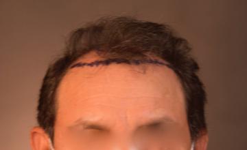 Dr. Arocha | Early 4-Month Results | 2500 graft FUT