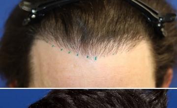 Before and After Hairline Repair