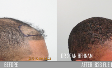 Right side before and after hair transplant