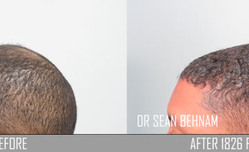 Left side before and after hair transplant