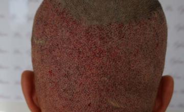 Back of patient, showing donor area immediately after FUE
