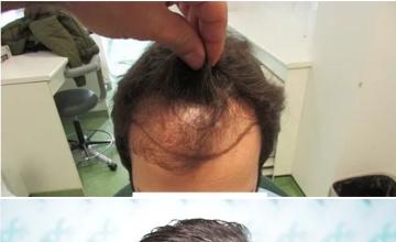 Top down hairline