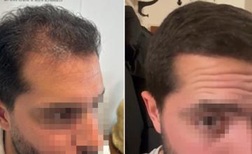 Before and after hair transplant