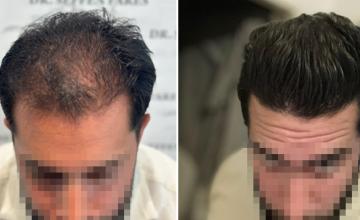 Before and after top view