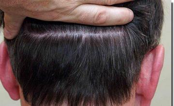 Hair restoration procedure results