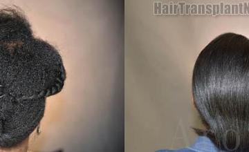Hair replacement surgery before and after images
