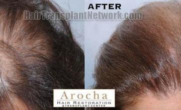 Hair restoration procedure results