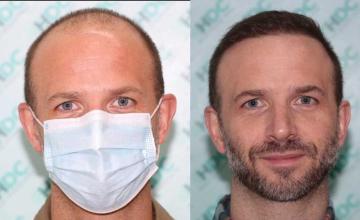 Front before and after FUE surgery