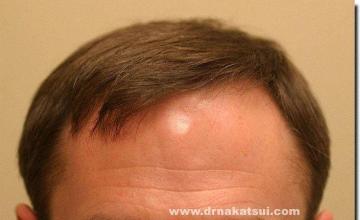 Hair restoration procedure results