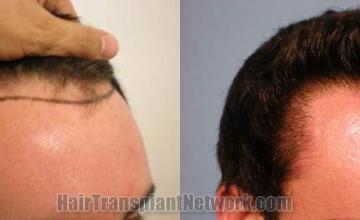 before and after photos