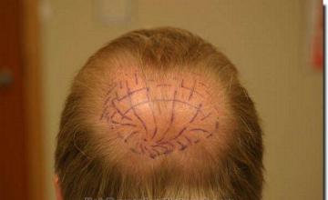 Hair restoration procedure results