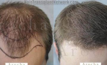 Hair restoration procedure before and after results