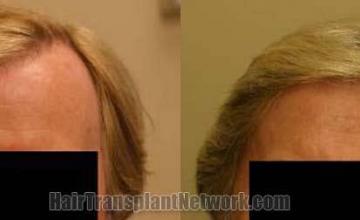 Front view - Before and after