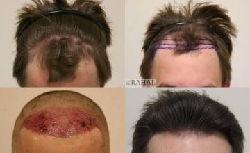Front view - Before and after  
