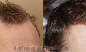 Hair transplantation surgery before and after images