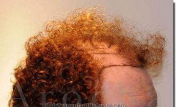 Hair restoration procedure results