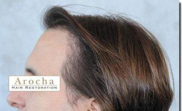 Hair restoration procedure results