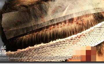 Hair restoration procedure results