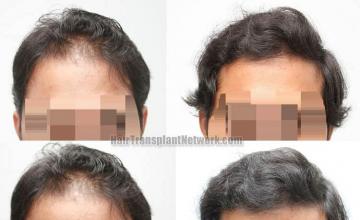 Hair restoration procedure before and after results