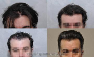 Front view - Before and after