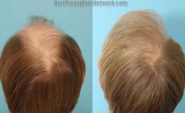  before and after photos