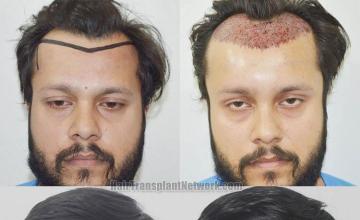 Front view - Before and after 