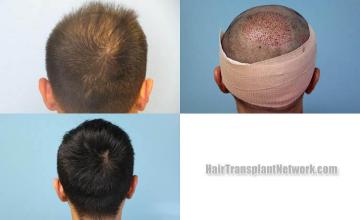 Hair transplantation surgery before and after images