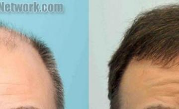 Front view - Before and after  