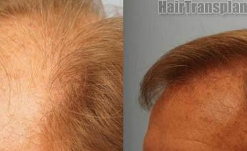 Hair restoration procedure before and after pictures