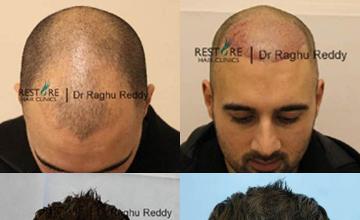 Hair transplantation surgery before and after photos