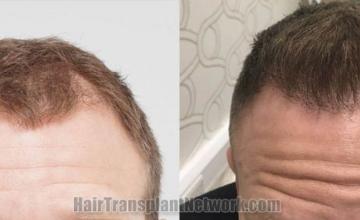 Front view - Before and after  