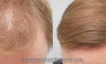Front view - Before and after  
