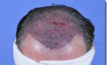 Hair restoration procedure results