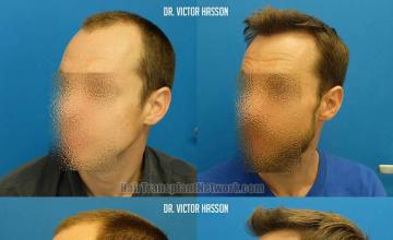Before and after hair transplant procedure images