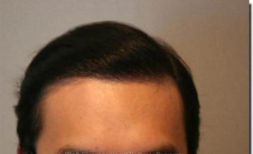 Hair restoration procedure results