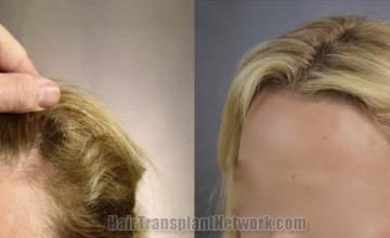 Hair transplantation surgery before and after images